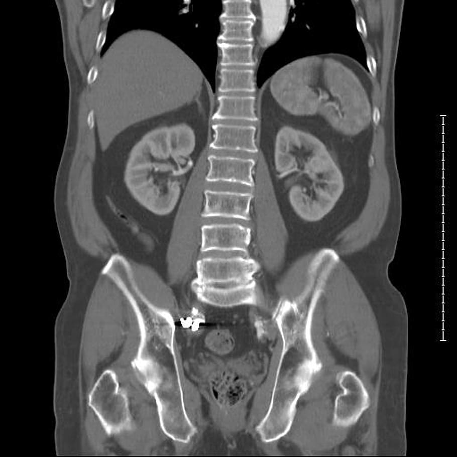 Pelvic MRI